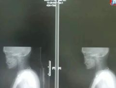 一张CT片子套多个病历？医生实名举报！国家医保局出手